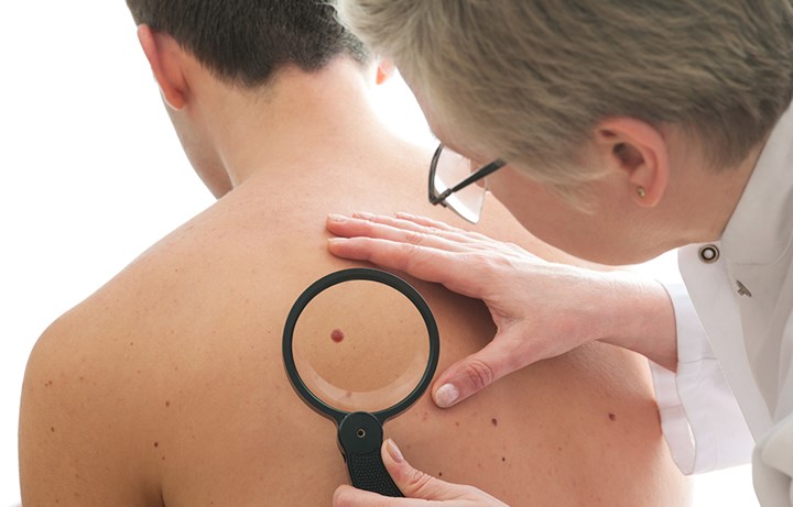 skin cancer check